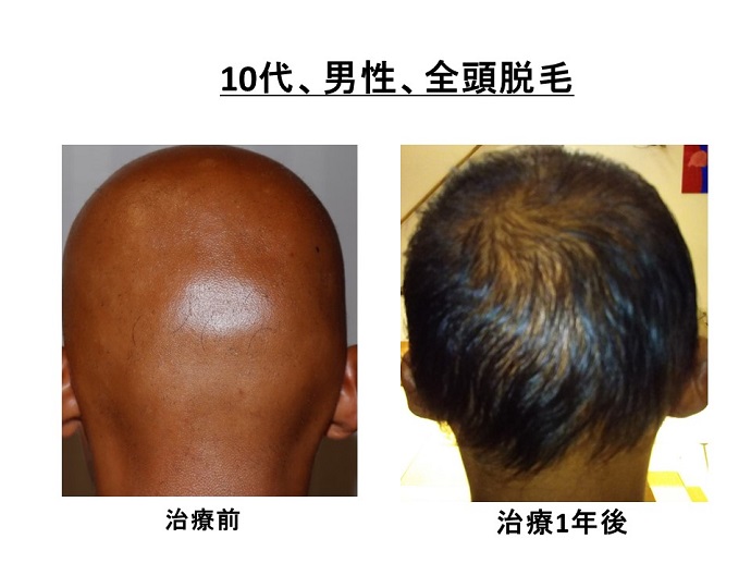 円形脱毛症　病院